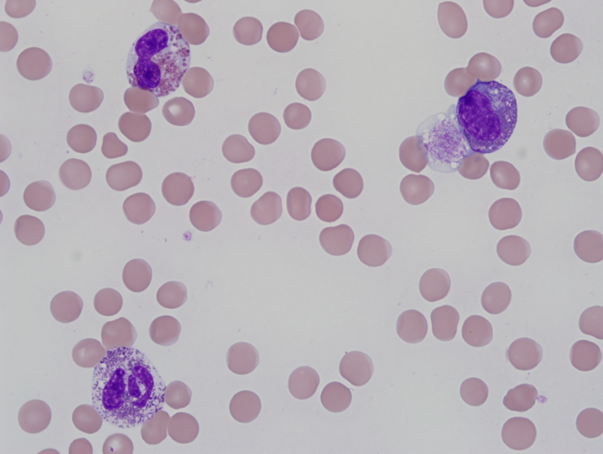 BM biopsy 1 peripheral blood 100x